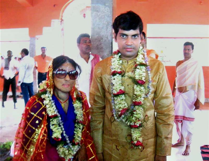 acid attack, acid attack victim marriage
