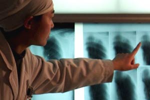 Tuberculosis