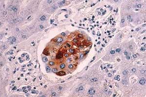 pancreatic cancer