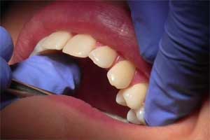 The findings showed that individuals with less than 20 teeth were at a 20 percent higher risk for developing cognitive decline and dementia than those with greater than or equal to 20 teeth.(Reuters)