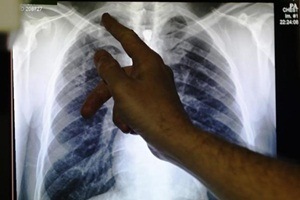 chronic obstructive pulmonary disease, lung patients, tiny coils improve quality of life