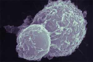 New rare form of hereditary colon cancer identified