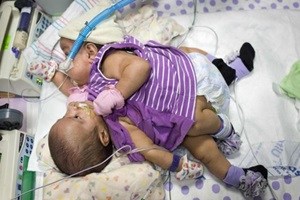 Rare conjoined twins born in Mumbai hospital Rare conjoined twins born in Mumbai hospital