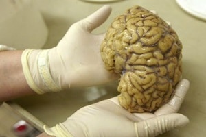 Still, complete surgical removal of tumour is nearly impossible, as these cells are also radio and chemotherapy resistant.(Reuters)