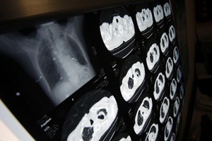 To lower the risks of adverse events, the thinking has been to prescribe less potent or lower dosage opioids. (Reuters)