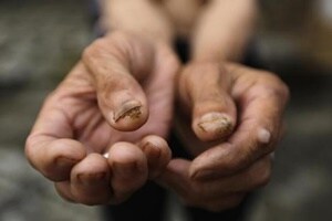 Skin self-examination and clinician skin examination are a means of early detection. (Reuters)