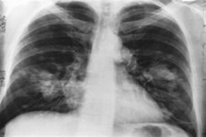 Reducing the levels of BMI1 by genetic means, or by using a drug reducing expression of BMI1, led to inhibition of tumour formation, the findings showed. (Reuters) 