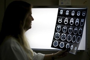 Researchers looked for mutational signatures in 12 patients with secondary radiation-associated tumours, comparing these with 319 that had not been exposed to radiation. (Reuters) Researchers looked for mutational signatures in 12 patients with secondary radiation-associated tumours, comparing these with 319 that had not been exposed to radiation. (Reuters)