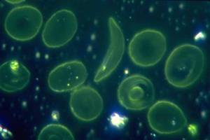 For the first time, researchers have corrected the mutation in a proportion of stem cells that is high enough to produce a substantial benefit in sickle cell patients. (Reuters) For the first time, researchers have corrected the mutation in a proportion of stem cells that is high enough to produce a substantial benefit in sickle cell patients. (Reuters)