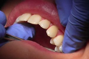 The new bioactive glass composites are unique in their ability to release fluoride as well as the significant quantities of calcium and phosphate that are needed to form tooth mineral, according to researchers from Queen Mary University of London in the UK. (Reuters)