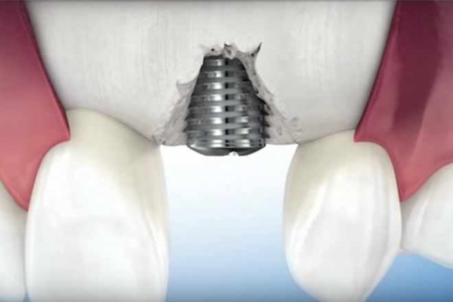 A team of researchers has come up with a new method to reduce dental implant failure. (YouTube)