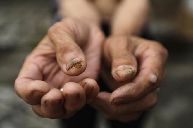 The researchers aim to incorporate carvedilol or similar beta blockers into a skin cream or spray that could hopefully be used to prevent skin cancer arising from UV light exposure. (Reuters) The researchers aim to incorporate carvedilol or similar beta blockers into a skin cream or spray that could hopefully be used to prevent skin cancer arising from UV light exposure. (Reuters)