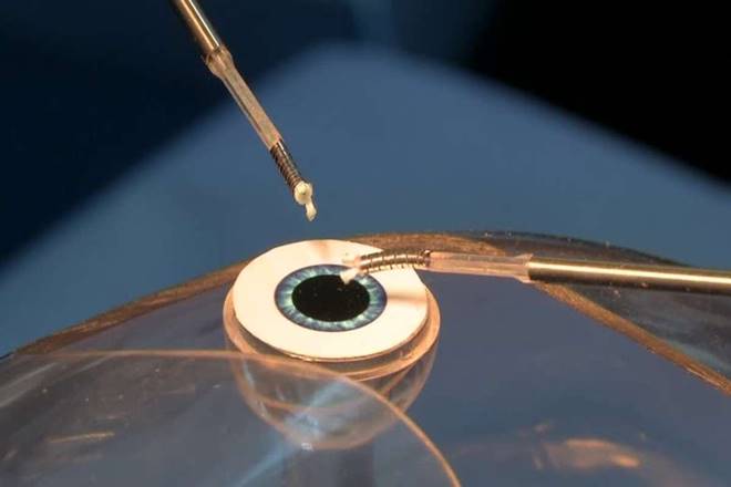 The system can provide high precision at 10 microns in all three primary directions, which is about 10 times more precise than what a surgeon can do. (Representational Image: Reuters)