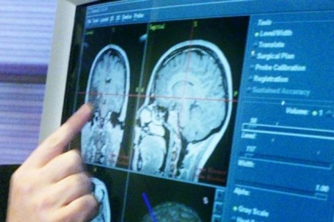 Researchers will test the possibility of using the Zika virus as a weapon to target and destroy brain tumour cells, which might lead to new cancer treatments, Cancer Research UK announced. (Reuters) Researchers will test the possibility of using the Zika virus as a weapon to target and destroy brain tumour cells, which might lead to new cancer treatments, Cancer Research UK announced. (Reuters)