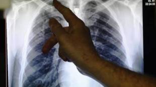 tuberculosis, lack adequate nutrition,  Global Hospital & Research Centre, BMI level, IndiaSpend,Department of Medicine