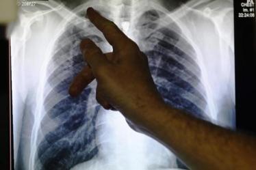 According to the study, published in the prestigious Lancet medical journal, drug-resistant TB could make up one in ten cases of the disease in the country by 2040. (Reuters)
