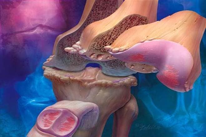 osteoarthritis, senescent cells, remove old cells, degenerative joint disease, anterior cruciate ligament transection (ACLT) surgery, UBX0101 injections, Nature Medicine, Mayo Clinic College of Medicine, the Buck Institute for Research on Aging, the University Medical Center Groningen, Unity Biotechnology, Inc., University of California, Berkeley