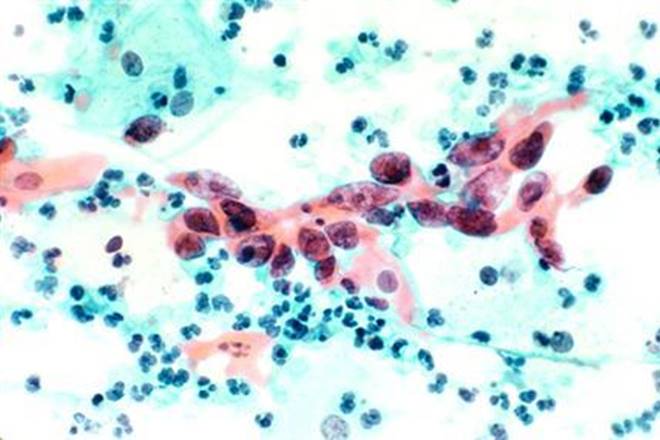 Cancer, MedGenome, TRAC, Cancer Immunotherapy solution, cancer drugs, cancer treatment
