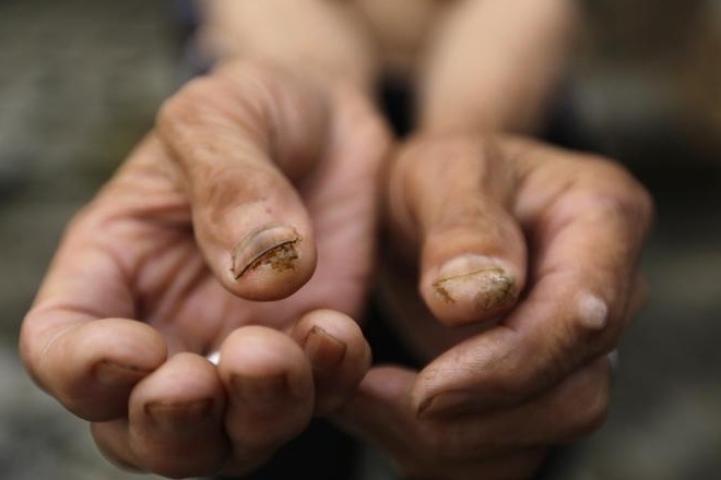 skin cancer, arthritis drug to cure skin cancer, skin cancer cure, new drug for skin care