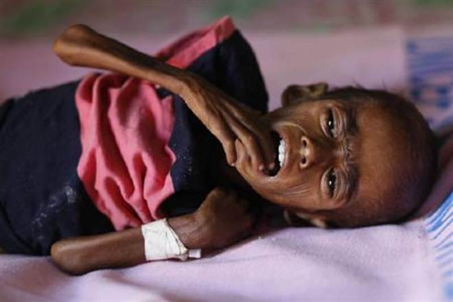 GDP, india economy, economy fall, GDP fall, GDP loss, health problems, India, India Malnutrition, underweight, Niti Aayog, Swachh Bharat, Swasth Bharat, Kuposhan, Kuposhan Mukt Bharat, Narendra Modi