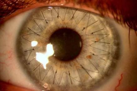 Jeewan S Titiyal, corneal transplants, AIIMS, JS Titiyal, Rajendra Prasad Centre, Dr Rajendra Prasad Centre for Ophthalmic Sciences, All India Institute of Medical Sciences, india Jeewan S Titiyal, corneal transplants, AIIMS, JS Titiyal, Rajendra Prasad Centre, Dr Rajendra Prasad Centre for Ophthalmic Sciences, All India Institute of Medical Sciences, india