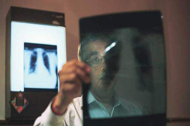 tuberculosis