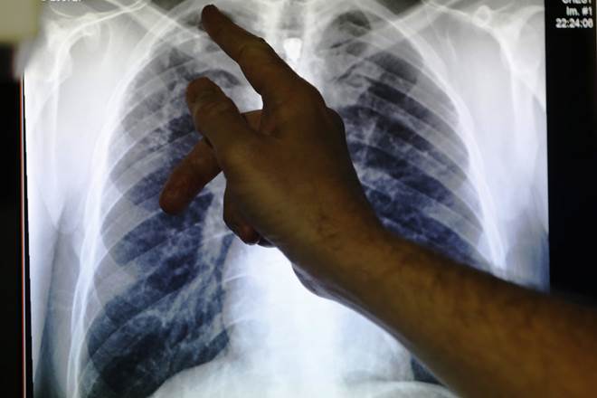 TB, TB treatment, TB in india, tuberculosis, Tb symptoms, TB disease, preventive therapy for TB, tb test, tb meaning, TB treatment in india, TB treatment side effects, TB treatment cost, TB treatment in homeopathy, india, china, paediatric tuberculosis, health