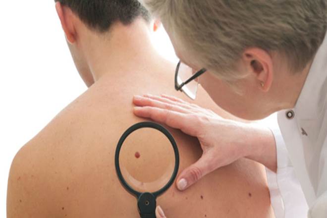 In a trial involving 105 people with melanoma and 104 healthy controls, the blood test was able to detect early stage melanoma in 79 per cent of cases. (IE)