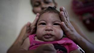 Zika virus, miscarriage, stillbirths, pregnancy, zika infections, research centers, california, davis, symptoms, pathological lesions, brain abnormality