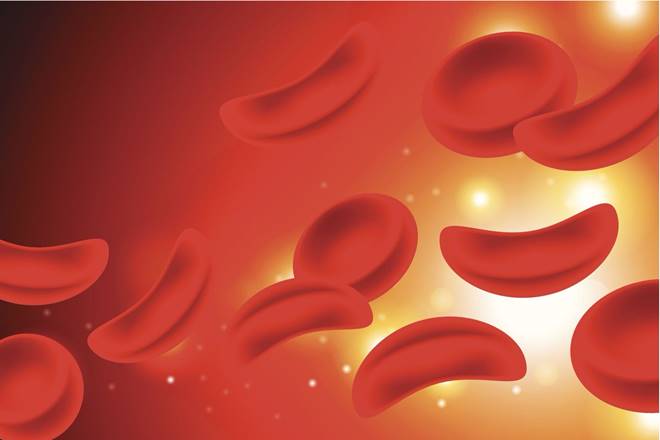 Sickle cell anemia, Sickle cell anemia causes, Sickle cell anemia diagnosis, Sickle cell anemia treatment, Sickle cell anemia symptoms, Sickle cell anemia prevention, Sickle cell disease, Sickle cell disease causes, Sickle cell disease symptoms, Sickle cell disease treatment, Sickle cell disease study