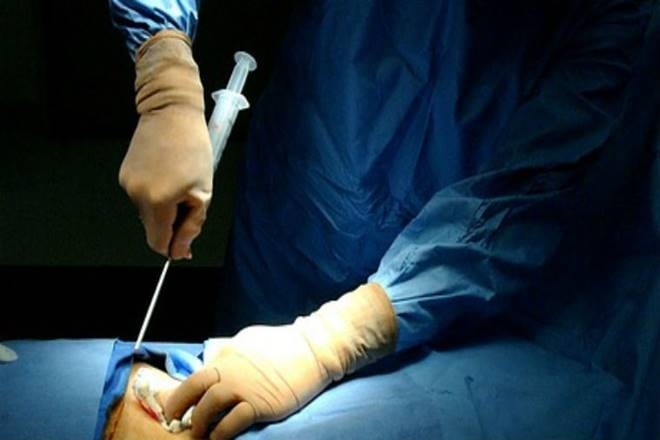 The researchers injected 2.4 million iPS cells into the left side of the patient's brain, in an operation that took about three hours. If no problems are observed in the coming six months, they will implant another 2.4 million cells into the right side. 