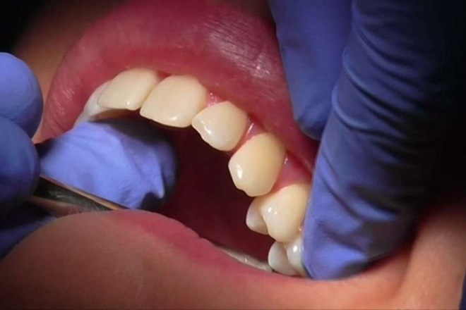 Here's a complete guide to what India's first dental health package covers. (Image: Reuters)