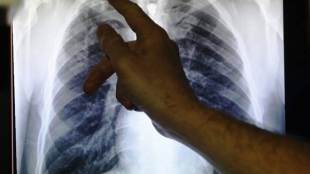 tb treatment, tb control program, tb mission 2020, tb control program in india