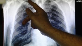 TB, South East Asia Region, WHO, UN General Assembly, TB-HIV mortality, TB cases, TB patients, drug resistant TB