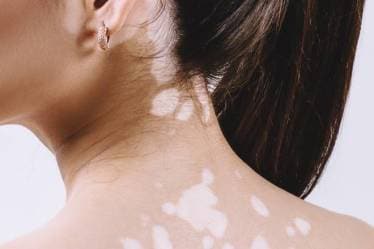 Vitiligo, leucoderma, Vitiligo symptoms, Vitiligo causes, Vitiligo treatment, Vitiligo myths, vitiligo causes, Vitiligo dermatologist