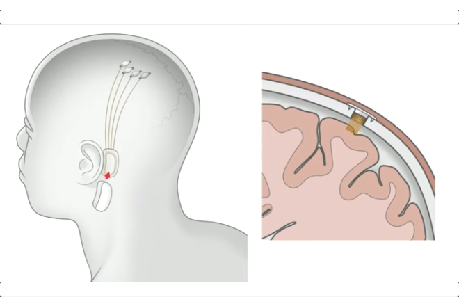 Tesla CEO Elon Musk announces Neuralink as he takes up linking human brain with computer Tesla CEO Elon Musk announces Neuralink as he takes up linking human brain with computer