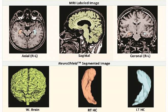 The analysis of NEUROShield enables actionable, quantitative, objective decision making to the neuro-physicians for differential diagnosis.