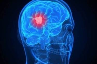 brain tumours, brain cancer, brain tumour symptoms, brain tumour treatment, endoscopy