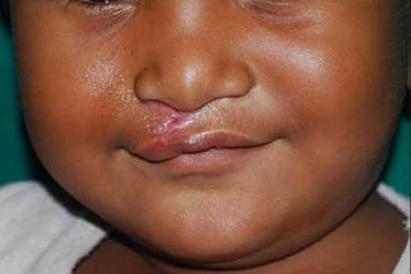 cleft, cleft in india, global healthcare access,  India Universal Immunization Programme, cleft lip, orthodontic treatment, cleft treatment, latest news on cleft