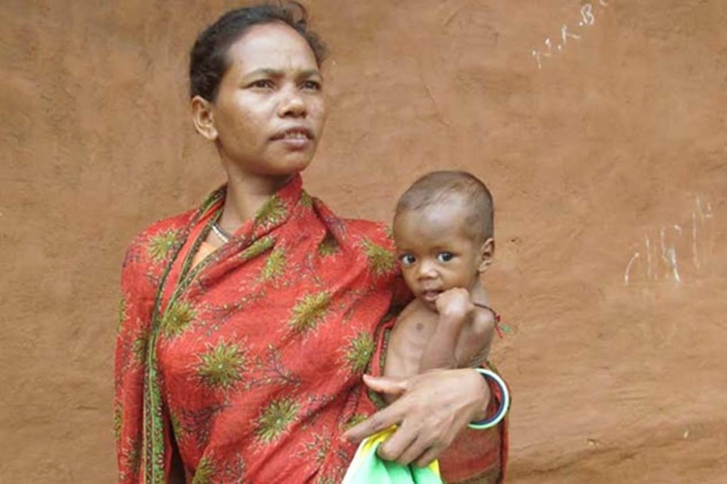 In a written reply in the Upper House, Women and Child Development Minister Smriti Irani said identification and management of severe acute malnutrition is an ongoing process. (Representative image)