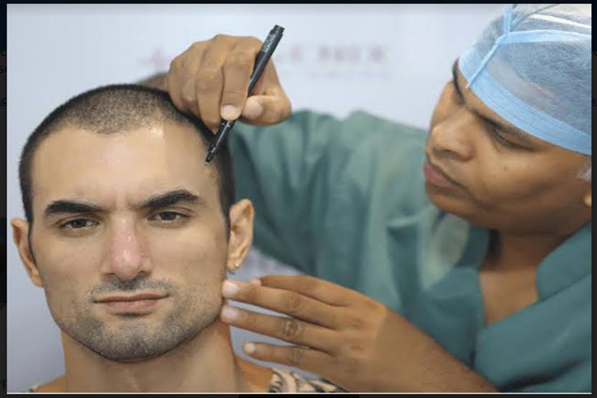 men hair transplant