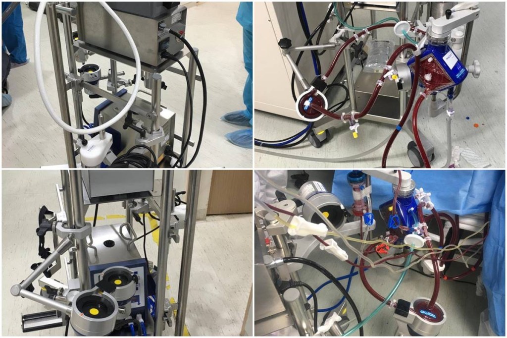 ECMO, Extra Corporeal Membrane Oxygenation, COVID pandemic, Catheter, ECMO side effects, Dr Rajesh Mohan Shetty, Manipal Hospital