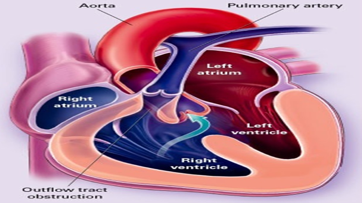 congenital heart defects, CHD, pink babies, blue babies, X-Ray, cath lab, open-heart surgery