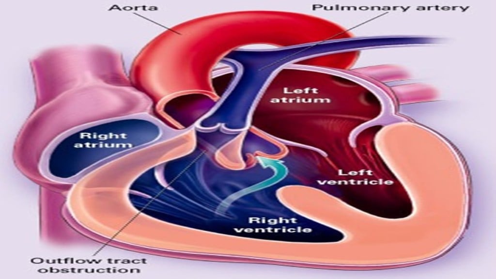 congenital heart defects, CHD, pink babies, blue babies, X-Ray, cath lab, open-heart surgery