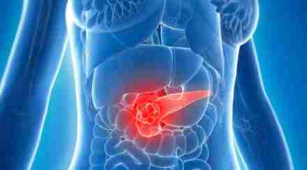 The experiment showed that the ketogenic diet changes pancreatic cancer metabolism and their response to chemotherapy.