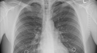 chest x ray, health care, tuberculosis, diagnostic news,
