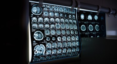 sclerosis, sclerosis in India, sclerosis diagnosis, treatment,