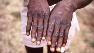 monkeypox, monkeypox in India
