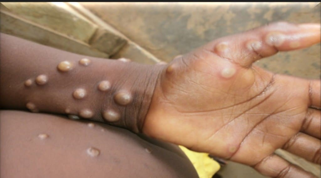 The U.N. health agency said this week that outside of Africa, 99% of all reported monkeypox cases are in men and of those, 98% are in men who have sex with other men. (IE)