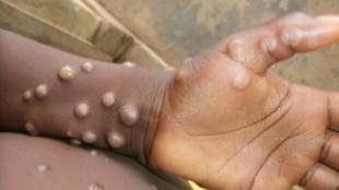 Kerala reports India's first monkeypox case; Centre rushes high-level team for effective management